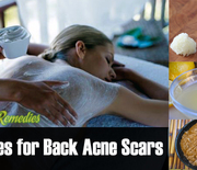 Thumb_back-acne-scars-remedies