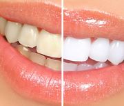 Thumb_5-home-remedies-for-whiter-teeth