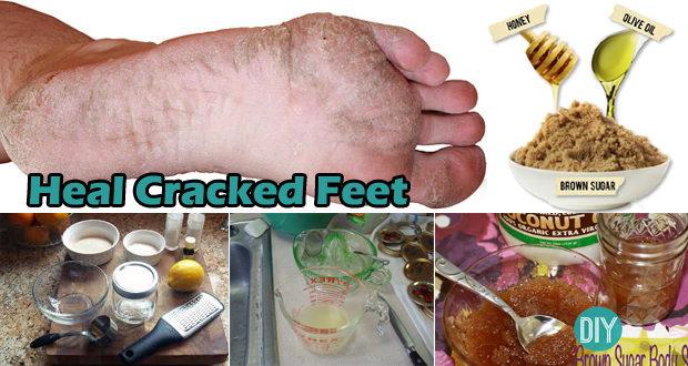 Ways-to-heal-cracked-feet