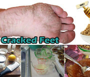 Thumb_ways-to-heal-cracked-feet