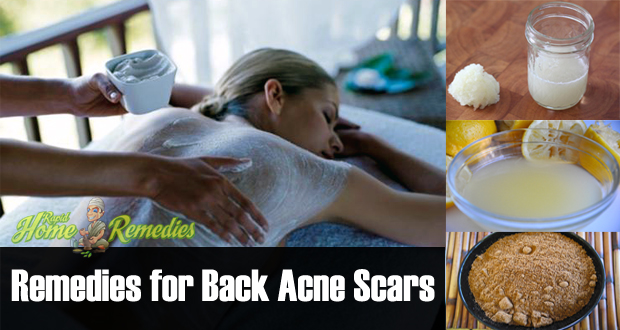 Back-acne-scars-remedies