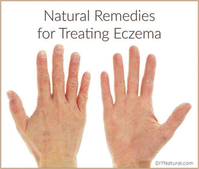 Natural-remedies-for-eczema-660x562