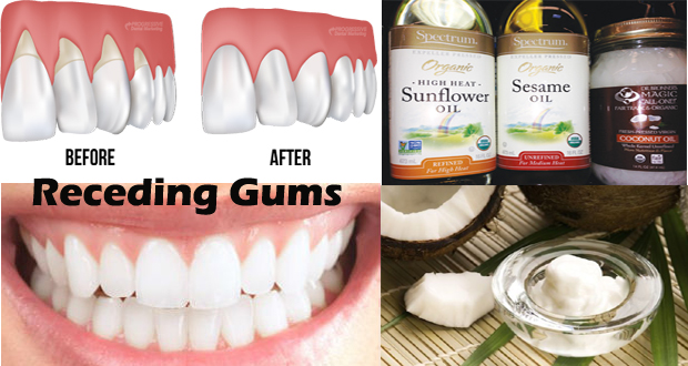 Remedies-for-receding-gums