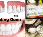 Thumb_remedies-for-receding-gums