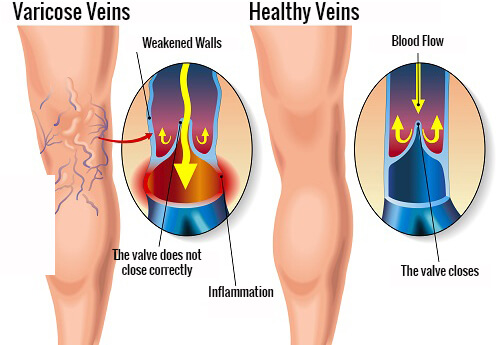 Varicose-veins-copy