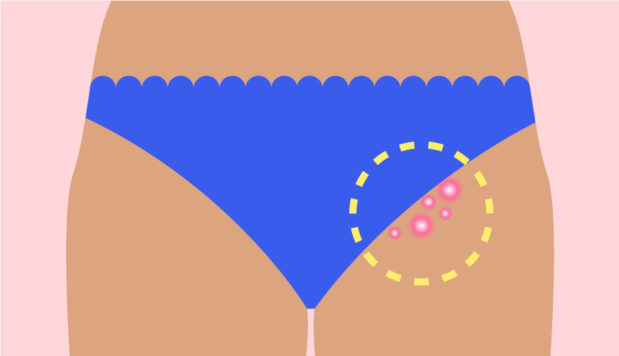 Painful-bumps-bikini-line_feature